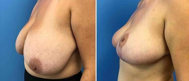 Breast Reduction result at CosmetiCare Plastic Surgery Newport Beach & Med Spa in Newport Beach, CA