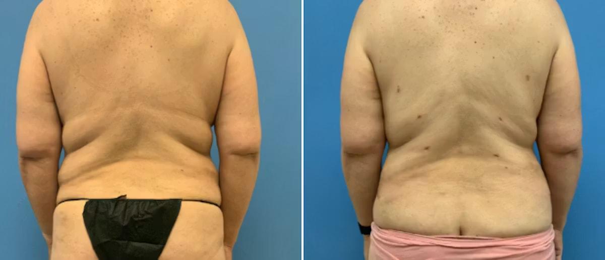 CosmetiCare Plastic Surgery Newport Beach & Med Spa mommy makeover result — Newport Beach, CA