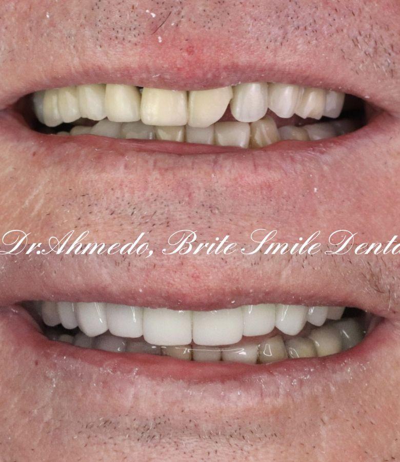 Brite Smile Dental dental crowns after — San Diego, CA