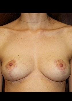 Charlotte Ann Rhee, MD breast reduction after — Huntington Station, NY