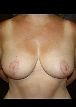 Charlotte Ann Rhee, MD breast reduction after — Huntington Station, NY