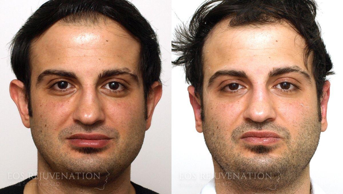 Eos Rejuvenation otoplasty result — Beverly Hills, CA