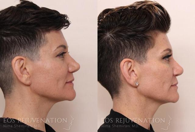 Rhinoplasty result at Eos Rejuvenation in Beverly Hills, CA