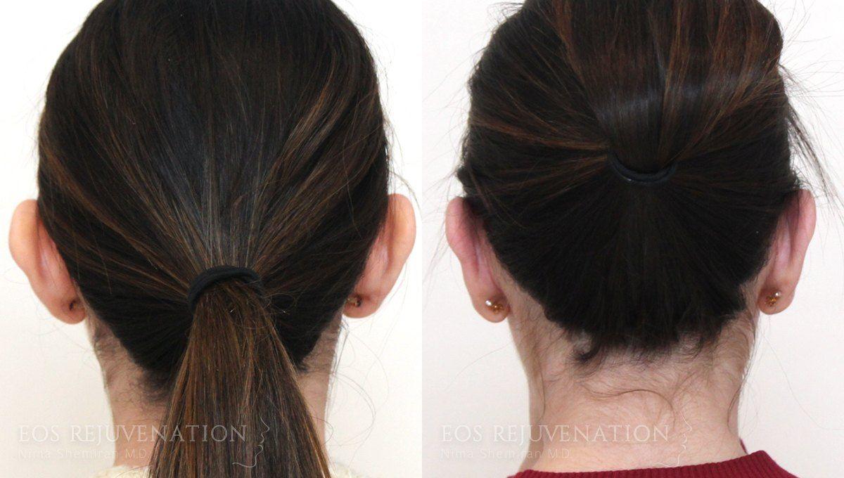 Eos Rejuvenation otoplasty result — Beverly Hills, CA