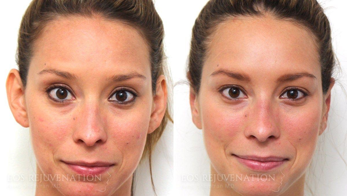 Eos Rejuvenation ear pinning result — Beverly Hills, CA