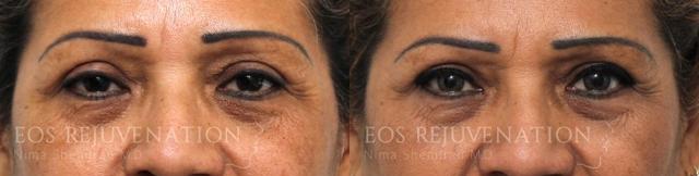 Blepharoplasty result at Eos Rejuvenation in Beverly Hills, CA