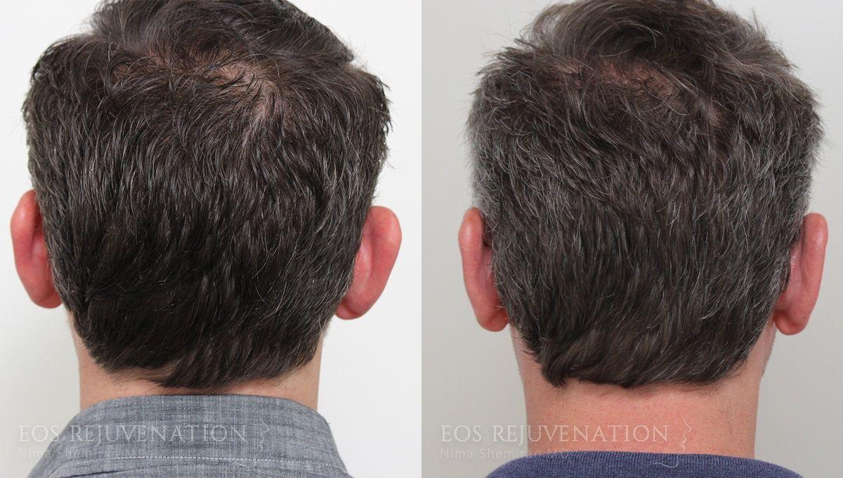 Eos Rejuvenation otoplasty result — Beverly Hills, CA