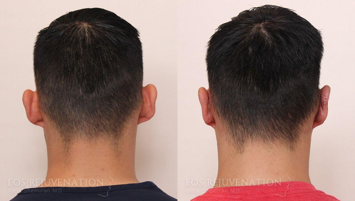 Eos Rejuvenation otoplasty result — Beverly Hills, CA