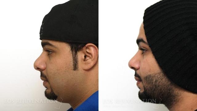 Rhinoplasty result at Eos Rejuvenation in Beverly Hills, CA