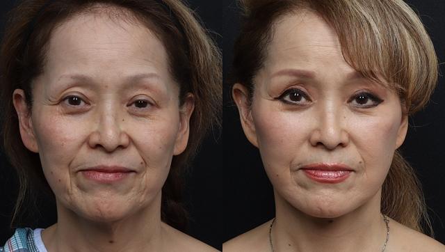 Facelift result at Eos Rejuvenation in Beverly Hills, CA