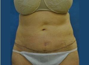 The Palm Beach Plastic Surgery Center (Richard G. Schwartz, MD) tummy tuck after — West Palm Beach, FL