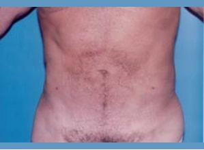 The Palm Beach Plastic Surgery Center (Richard G. Schwartz, MD) liposuction after — West Palm Beach, FL