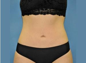 The Palm Beach Plastic Surgery Center (Richard G. Schwartz, MD) liposuction after — West Palm Beach, FL