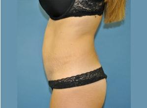 The Palm Beach Plastic Surgery Center (Richard G. Schwartz, MD) liposuction after — West Palm Beach, FL