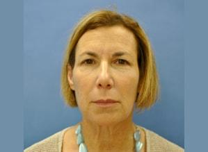 Facelift before at The Palm Beach Plastic Surgery Center (Richard G. Schwartz, MD) in West Palm Beach, FL