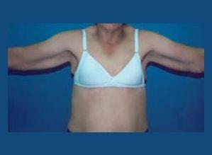 The Palm Beach Plastic Surgery Center (Richard G. Schwartz, MD) arm lift after — West Palm Beach, FL