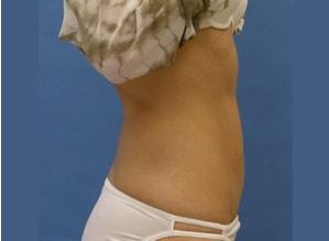 The Palm Beach Plastic Surgery Center (Richard G. Schwartz, MD) tummy tuck after — West Palm Beach, FL