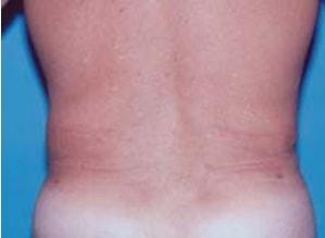 The Palm Beach Plastic Surgery Center (Richard G. Schwartz, MD) liposuction after — West Palm Beach, FL