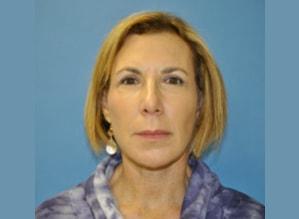 Facelift after at The Palm Beach Plastic Surgery Center (Richard G. Schwartz, MD) in West Palm Beach, FL