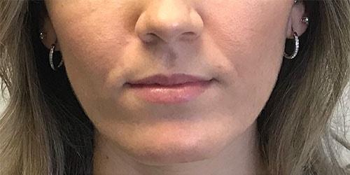 Lip Filler before at Z Facial Plastic Surgery - Dr. Zhuravsky in Aventura, FL