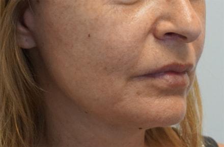 Z Facial Plastic Surgery - Dr. Zhuravsky facelift after — Aventura, FL