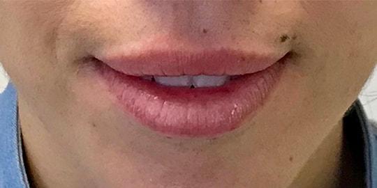 Lip Filler before at Z Facial Plastic Surgery - Dr. Zhuravsky in Aventura, FL