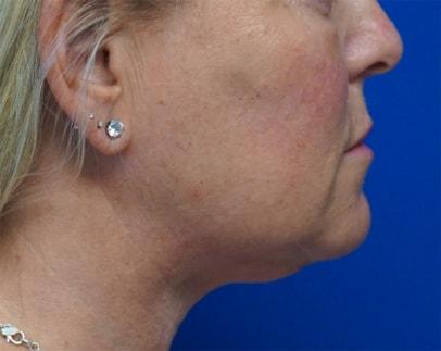 Z Facial Plastic Surgery - Dr. Zhuravsky facelift after — Aventura, FL
