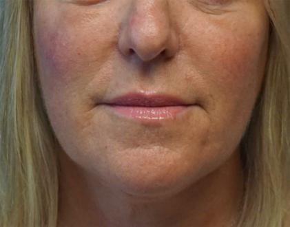 Z Facial Plastic Surgery - Dr. Zhuravsky facelift after — Miami, FL