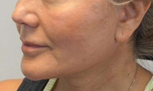 Z Facial Plastic Surgery - Dr. Zhuravsky facelift after — Aventura, FL