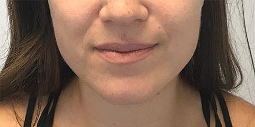 Lip Filler before at Z Facial Plastic Surgery - Dr. Zhuravsky in Aventura, FL