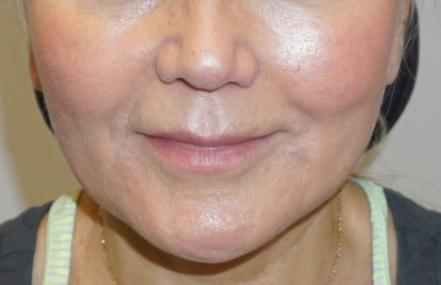 Z Facial Plastic Surgery - Dr. Zhuravsky facelift after — Miami, FL