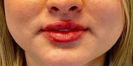 Lip Filler after at Z Facial Plastic Surgery - Dr. Zhuravsky in Aventura, FL