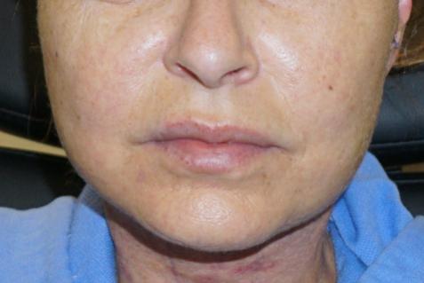 Z Facial Plastic Surgery - Dr. Zhuravsky facelift after — Miami, FL