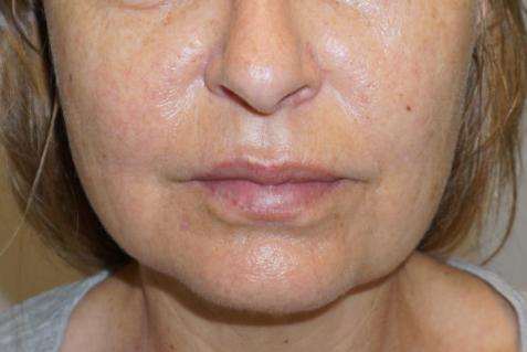 Facelift before at Z Facial Plastic Surgery - Dr. Zhuravsky in Miami, FL