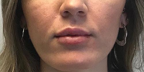 Lip Filler after at Z Facial Plastic Surgery - Dr. Zhuravsky in Aventura, FL