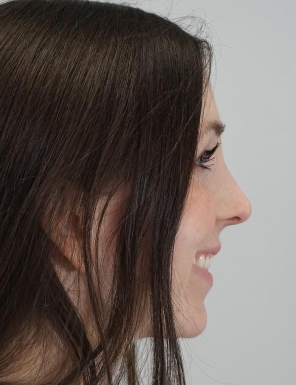 Functional Rhinoplasty after at Z Facial Plastic Surgery - Dr. Zhuravsky in Aventura, FL