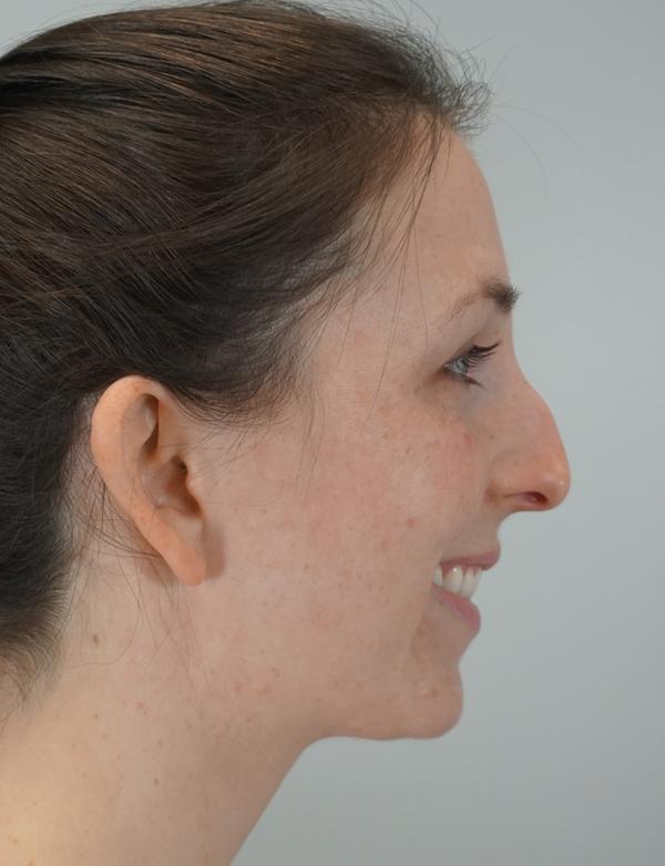 Functional Rhinoplasty before at Z Facial Plastic Surgery - Dr. Zhuravsky in Aventura, FL