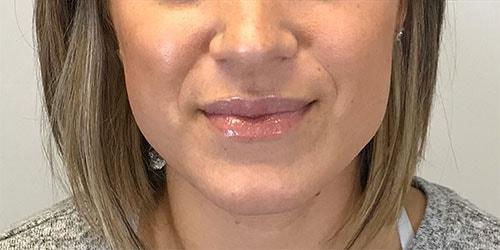 Lip Filler after at Z Facial Plastic Surgery - Dr. Zhuravsky in Aventura, FL