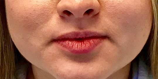 Lip Filler before at Z Facial Plastic Surgery - Dr. Zhuravsky in Aventura, FL