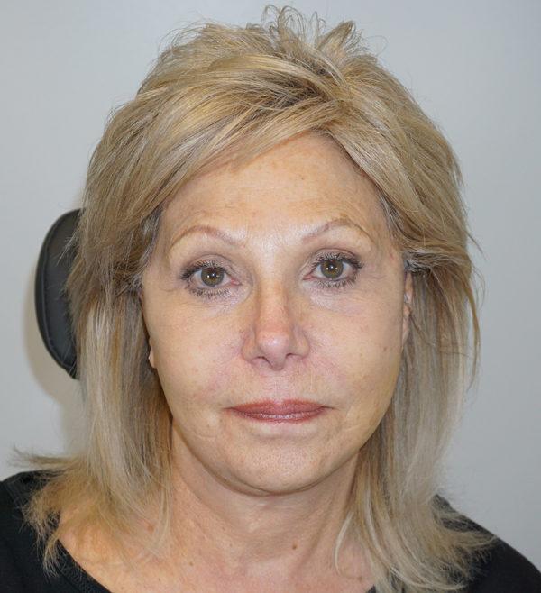 Z Facial Plastic Surgery - Dr. Zhuravsky facelift after — Miami, FL