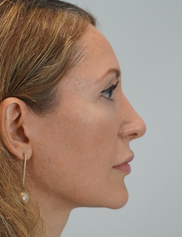 Functional Rhinoplasty after at Z Facial Plastic Surgery - Dr. Zhuravsky in Aventura, FL