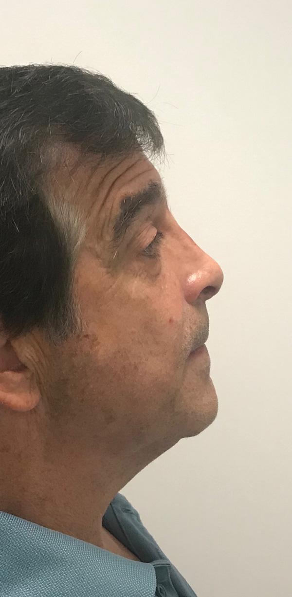 Z Facial Plastic Surgery - Dr. Zhuravsky rhinoplasty after — Miami, FL