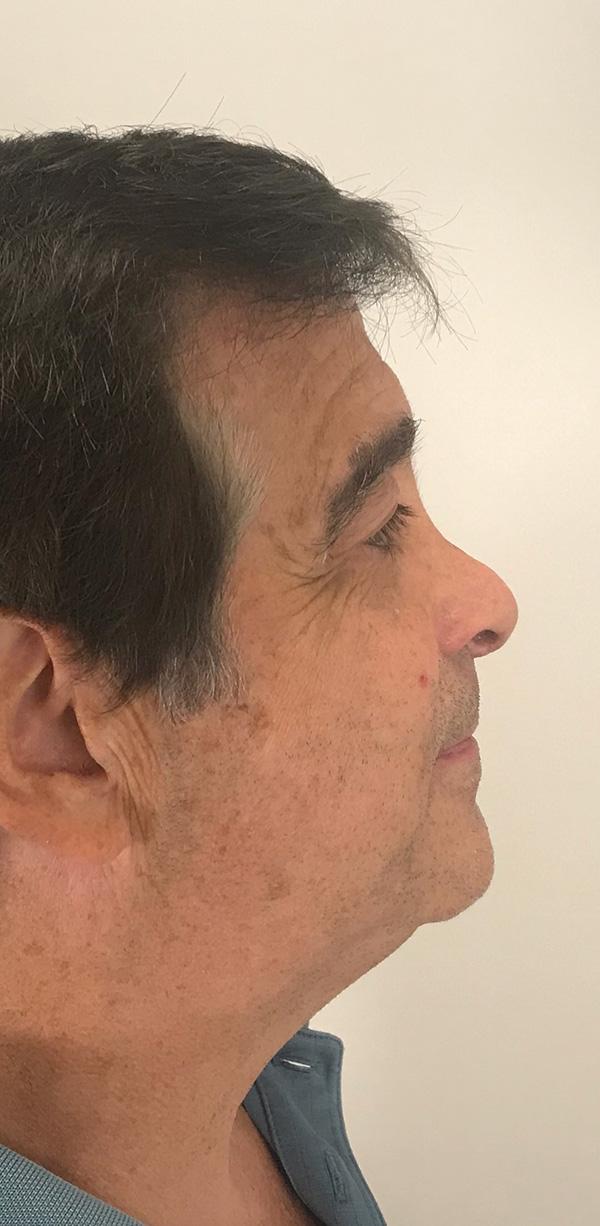 Rhinoplasty before at Z Facial Plastic Surgery - Dr. Zhuravsky in Miami, FL