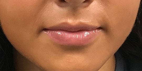 Lip Filler after at Z Facial Plastic Surgery - Dr. Zhuravsky in Aventura, FL
