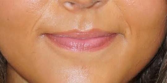 Lip Filler before at Z Facial Plastic Surgery - Dr. Zhuravsky in Aventura, FL