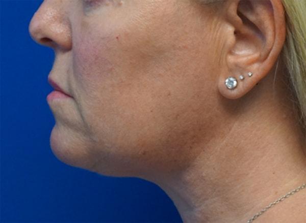 Z Facial Plastic Surgery - Dr. Zhuravsky facelift after — Aventura, FL
