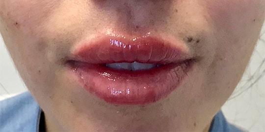 Lip Filler after at Z Facial Plastic Surgery - Dr. Zhuravsky in Aventura, FL