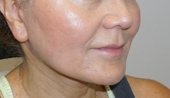 Z Facial Plastic Surgery - Dr. Zhuravsky facelift after — Aventura, FL