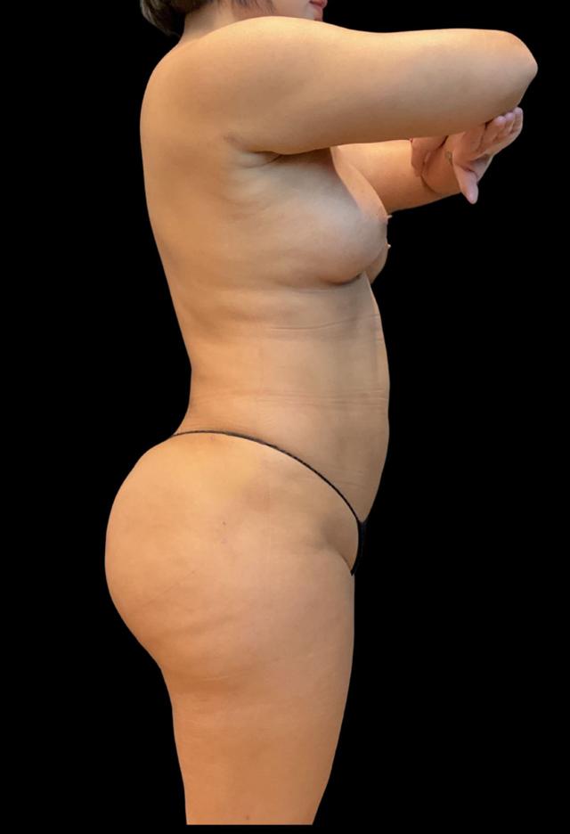 Brazilian Butt Lift after at Austin Plastic Surgeon in Austin, TX