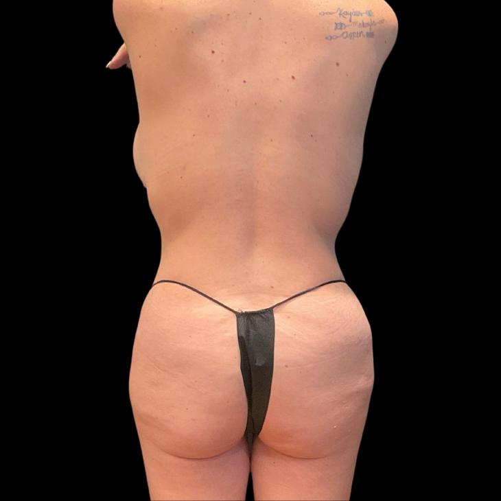 Austin Plastic Surgeon tummy tuck after — Austin, TX